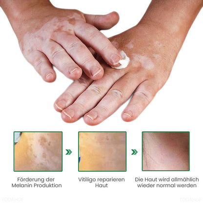 TODAHOF™  PRO Vitiligo Repair Revitalisierende Creme